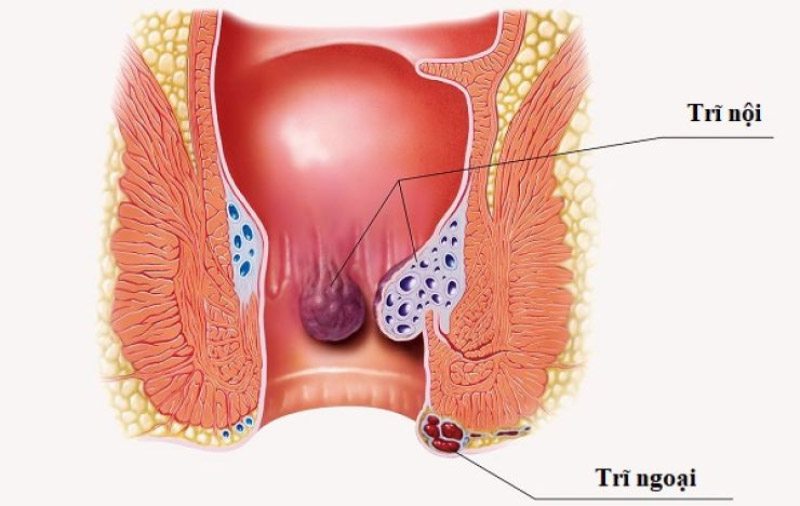 Trĩ xảy ra là do Khí huyết ở vùng đại trường bị trì trệ 