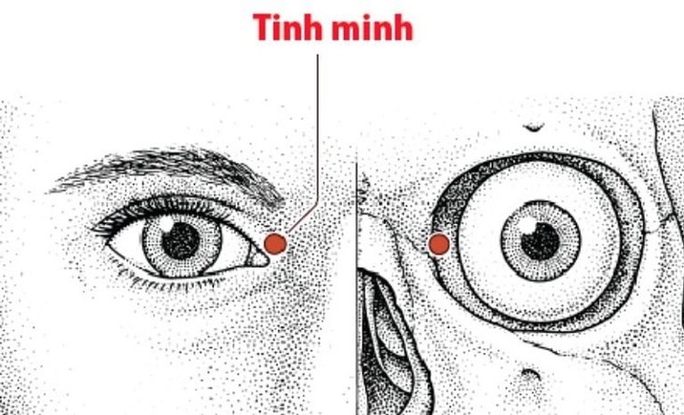 Vị trí huyệt Tình Minh trên gương mặt