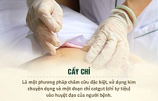 Cấy Chỉ Đông Y Giảm Cân Nên Hay Không, Chi Phí Thế Nào?