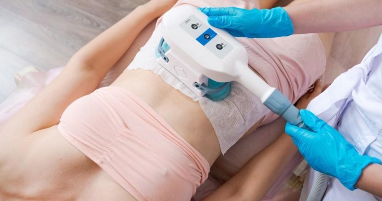 Loại bỏ mỡ vùng mu bằng phương pháp laser 