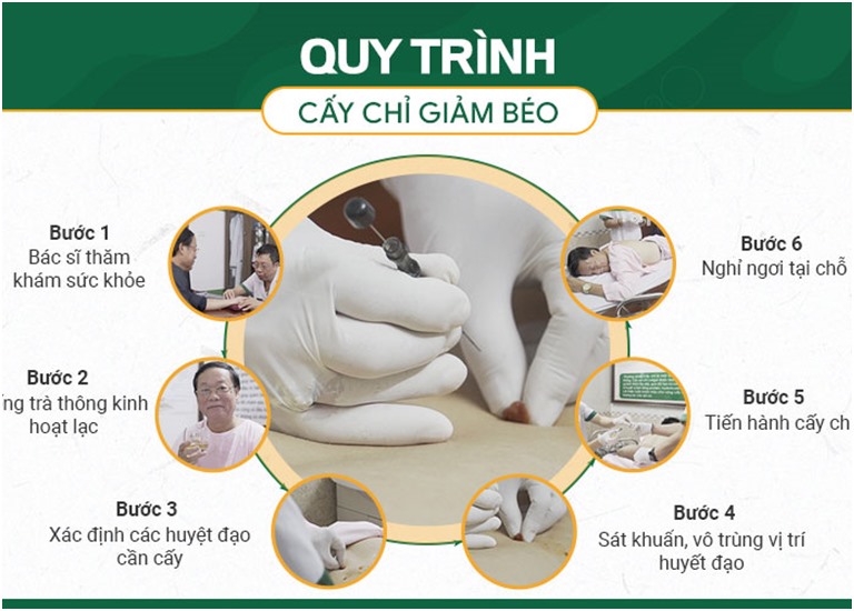 Quy trình cấy chỉ giảm béo chuyên nghiệp tại trung tâm Đông Phương Y Pháp