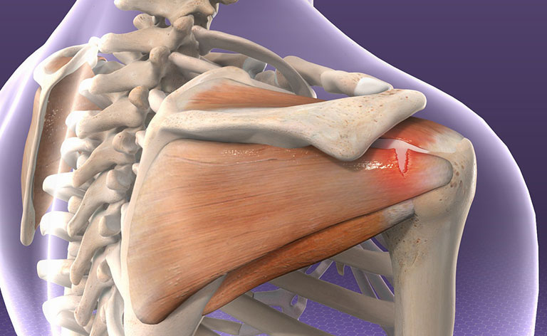 Tình trạng rách chóp xoay vai làm hạn chế tầm vận động của khớp