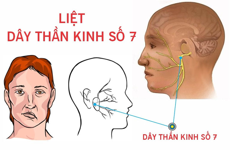 Hình ảnh liệt dây thần kinh số 7