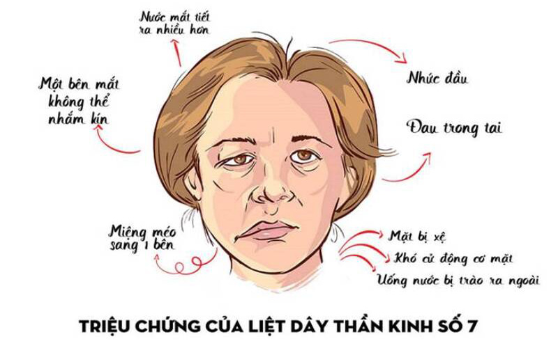 Một số triệu chứng dễ nhận biết khi liệt dây thần kinh số 7 ở mẹ bầu