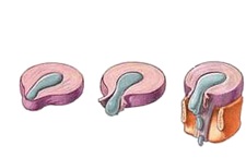 Các Giai Đoạn Thoát Vị Đĩa Đệm Cần Lưu Ý? Cách Điều Trị Hiệu Quả?