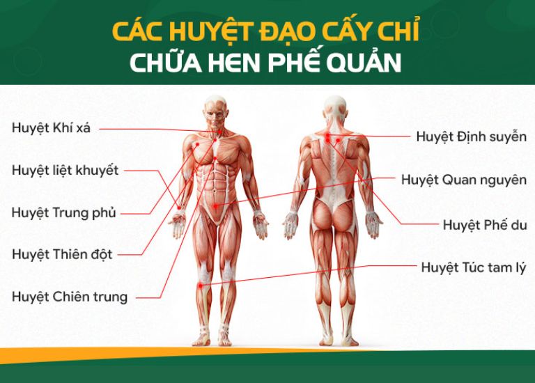 Các huyệt đạo được cấy chỉ để chữa hen