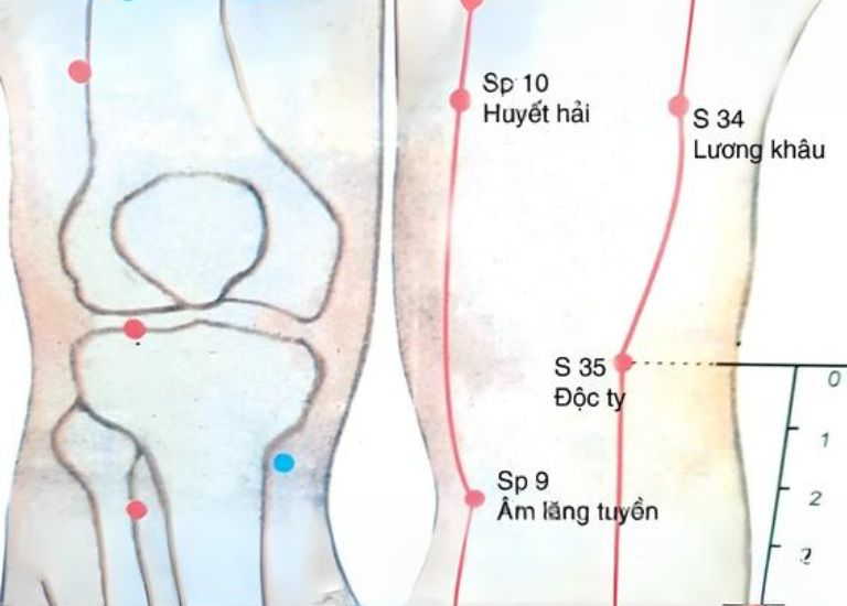 Một số huyệt đạo châm cứu khi bị thoái hóa khớp gối