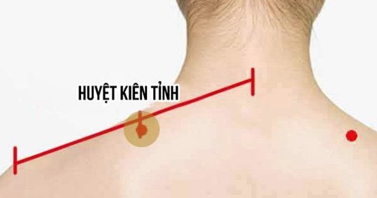 Huyệt Kiên Tỉnh được dùng để điều trị các bệnh về đau vai gáy