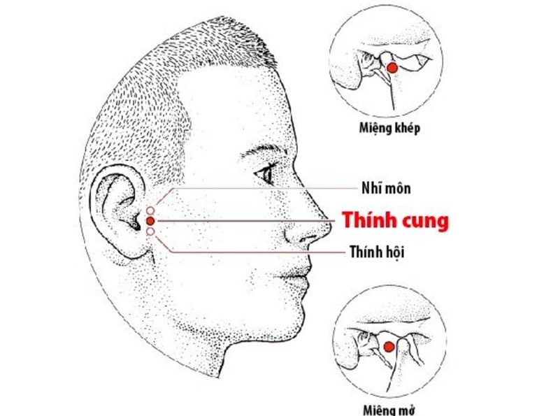 Vị trí của huyệt Thính Cung trên cơ thể