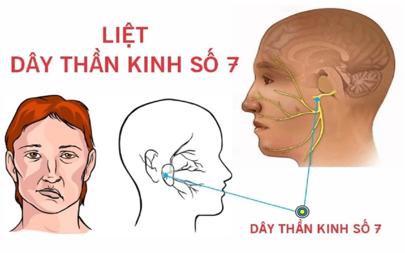 Nhiều người thắc mắc liệt dây thần kinh số 7 bao lâu thì khỏi