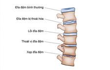 Lồi Đĩa Đệm Cột Sống Cổ Có Nguy Hiểm Không? Điều Trị Như Thế Nào?