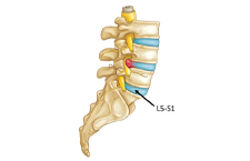 Lồi Đĩa Đệm L5 S1 Chữa Được Không? Đâu Là Nguyên Nhân Gây Bệnh?