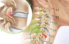 Thoát Vị Đĩa Đệm Cổ: Nguyên Nhân, Triệu Chứng Và Cách Điều Trị