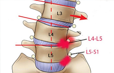 Thoát Vị Đĩa Đệm L4 L5 Là Gì? Nên Điều Trị Ra Sao?