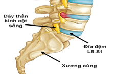 Thoát Vị Đĩa Đệm L5 S1: Nguyên Nhân, Triệu Chứng Và Cách Điều Trị