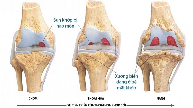 thoai hoa khop goi xquang