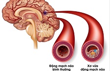 3 Cách Điều Trị Xơ Vữa Mạch Máu Não Mang Đến Hiệu Quả Cao