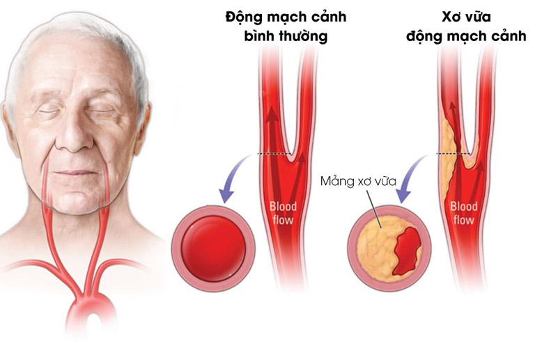 Mảng bám tích tụ ở lòng mạch gây xơ vữa động mạch cảnh