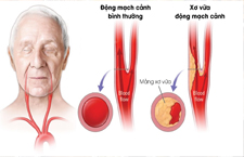 Bệnh Xơ Vữa Động Mạch Cảnh Có Chữa Được Không?