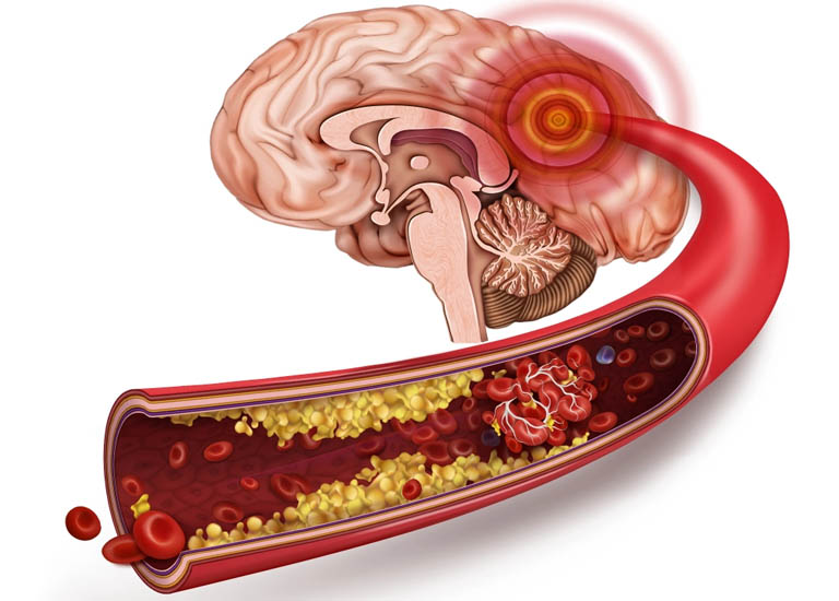 Xơ vữa mạch máu não làm giảm lượng oxy và dưỡng chất cung cấp lên vùng não
