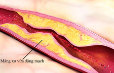 Xơ Vữa Động Mạch Là Bệnh Gì? Nguyên Nhân, Cách Điều Trị