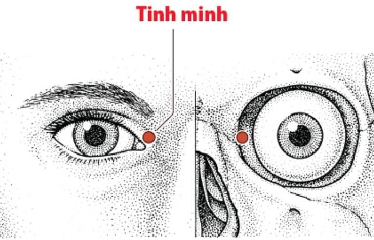 Bấm huyệt Tinh Minh chữa đau mắt 