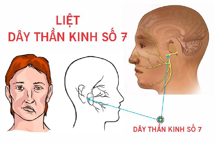 Bệnh Bell’s Palsy cần được phát hiện, chẩn đoán và điều trị sớm