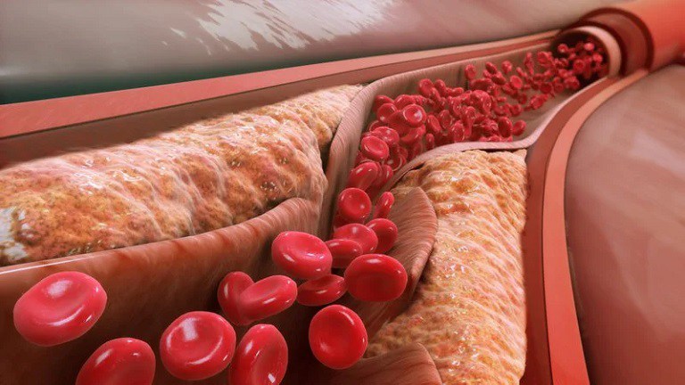 Gạo lứt có thể làm giảm mỡ thừa và cholesterol xấu