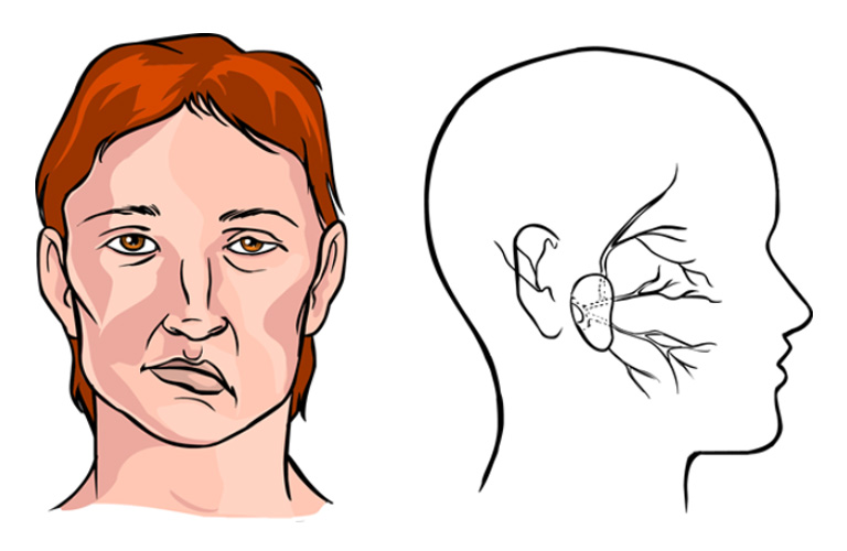 Bị liệt dây thần kinh số 7 có thể chữa khỏi được