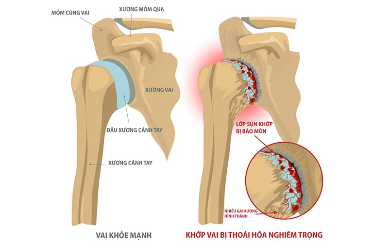 Thoái hóa khớp vai, viêm khớp vai là nguyên nhân gây bệnh phổ biến